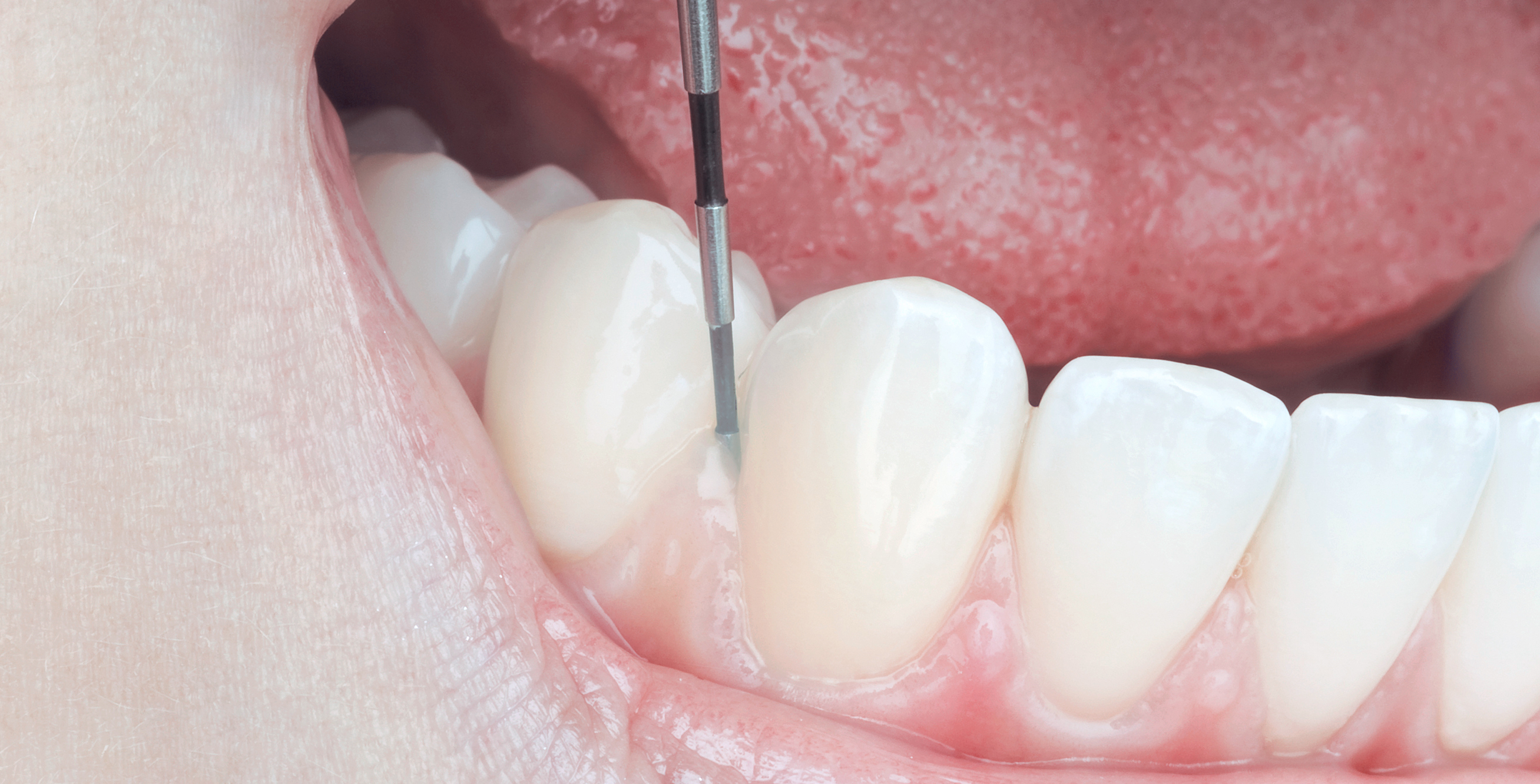 Nahaufnahme von Zähnen mit einem Dentalsonden-Check an den Zahnfleischrändern – typisch für eine parodontologische Untersuchung in der Zahnarztpraxis.
